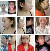 脂肪填充额头(脂肪填充额头眼睛肿了正常吗)