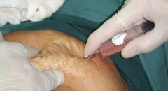 脂肪填充额头太高了怎么办(自体脂肪填充额头太高了怎么办)