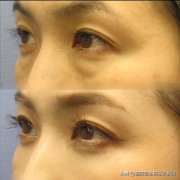 眼袋切除术需要多少钱(眼袋切除术需要多少钱才能做好)