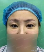 做眼袋好的医院是哪家医院好(做眼袋的医院排名)