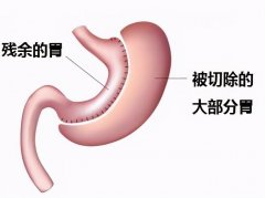 110斤吸脂可以瘦到80斤吗(110斤能瘦到80斤吗)