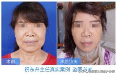 真人拉皮手术全过程(做拉皮手术全过程)