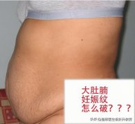 腹部拉皮和腹壁整形(腹部拉皮和腹壁整形多少钱)