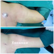 抽脂一个月了肚子还是大怎么办(抽脂以后肚子越来越大)