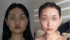 方脸削骨大概多少钱