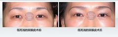 一般美容院做双眼皮多少钱(做双眼皮整形要多少钱)