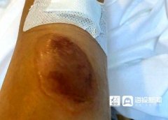 抽脂手术全称(抽脂手术种类)