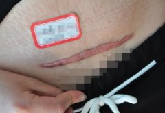 调节疤痕增生好的医院排名(疤痕增生哪家医院好)