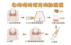 自体脂肪隆胸个人经历
