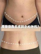 腰腹吸脂20天感觉就和没抽一样(腰腹抽脂抽了1500纯脂肪少吗)