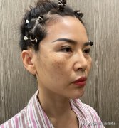 北京拉皮手术哪家医院好(北京拉皮手术排名)