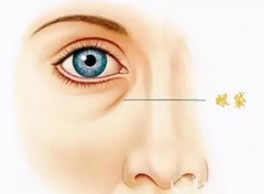 去眼袋一般多少钱(去眼袋怎么样)