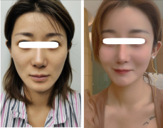 脂肪填充额头太饱满了怎么办(填充后额头太饱满怎么办)