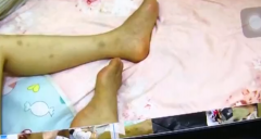 刮痧瘦腿 淤青