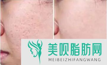面部轮廓整形后多长时间可以填充?面部整形麻药多久退?