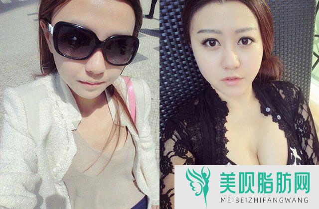 日本去疤膏什么牌子好?什么药膏去疤果好?