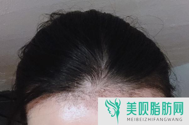 如何用盐和牙膏脱毛?冰点脱毛的正确步骤?