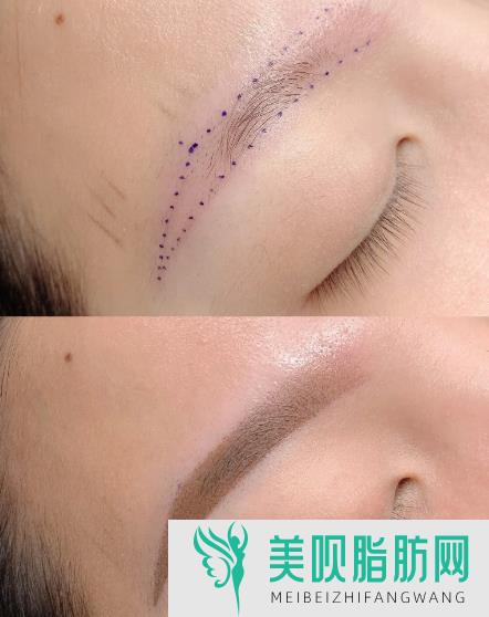 玻尿酸去黑眼圈注射小贴士