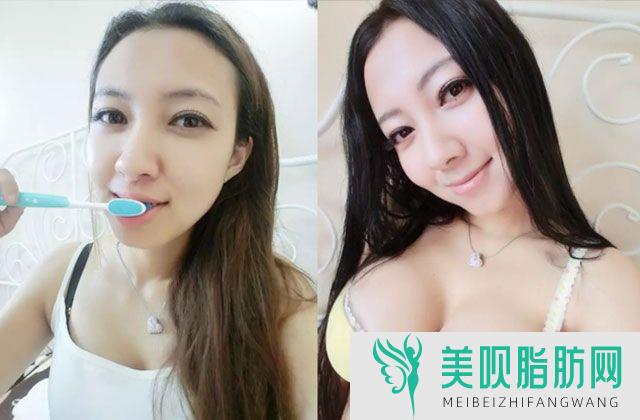 彩光嫩肤的原理,彩光嫩肤的作用