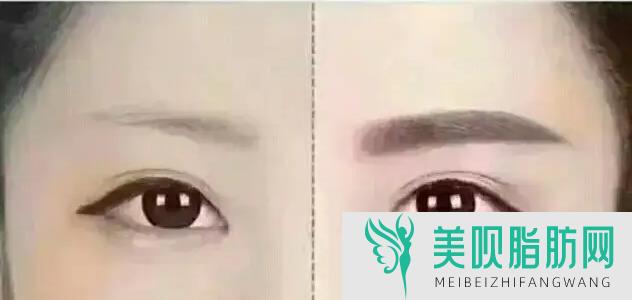 高手详解武汉祛眼袋术后如何护理,祛眼袋术后怎样护理更有利于恢复