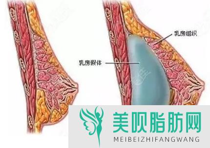 关于说说重庆自体脂肪丰胸果好吗,重庆哪里自体丰胸好