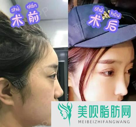 关于说说做了鼻整形变老后鼻子会怎么样,鼻子整形老了以后会怎么样