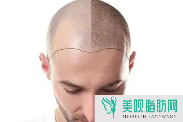 如何实现脱毛,如何实现脱毛果