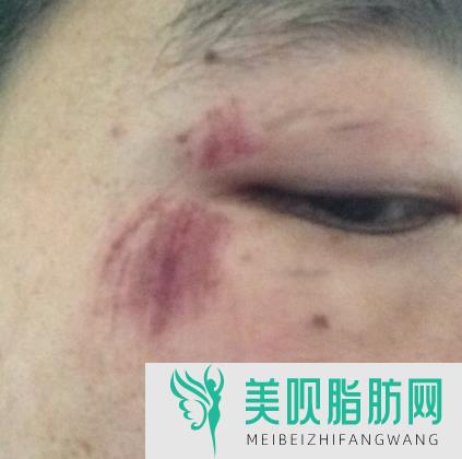 打几次能定型 打要注,打打几次可以定型