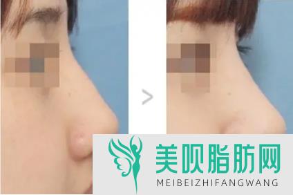 图文分析贵阳硅胶隆鼻果怎么样,贵阳做隆鼻