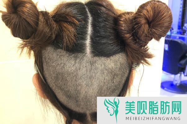 图文分析厦门冰点脱毛果怎么样,厦门冰点脱毛价格