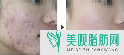 激光祛斑费用价格是多少(激光祛斑费用价格是多少钱)