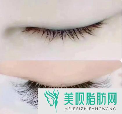 埋线双眼皮后脱线怎么办(埋线双眼皮后脱线怎么办)