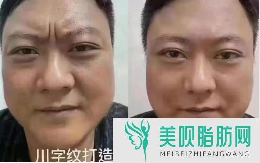 眉眼小拉皮适合什么人群(眉部小拉皮)