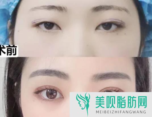 郑州整形医院一般做双眼皮手术多少钱(郑州整形医院一般做双眼皮手术多少钱啊)