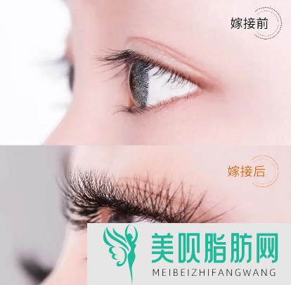 郑州整形医院做手术祛眼袋会有疤痕吗(郑州整形医院做手术祛眼袋会有疤痕吗多少钱)