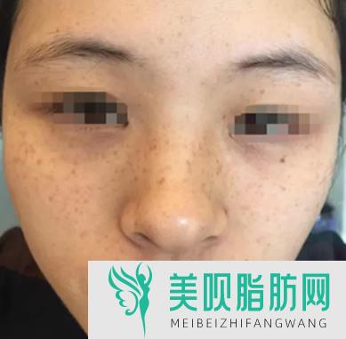 脂肪填充脸部恢复期是多久(脂肪填充脸部恢复期是多久啊)