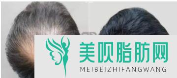 植发前要不要剃光头(植发需要剃光头吗)