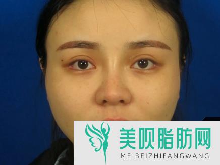 面部自体脂肪填充的副作用,面部自体脂肪填充的后遗症