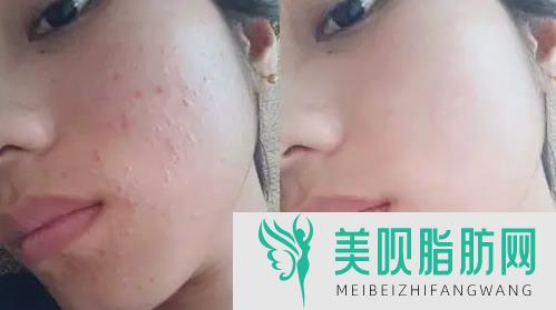 面部自体脂肪填充的副作用,面部自体脂肪填充的后遗症