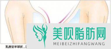 胸部缩小恢复期,胸部缩小会不会留疤