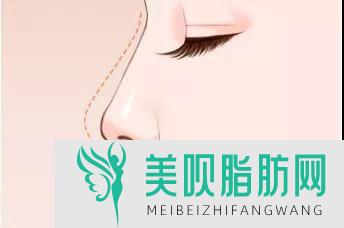 自体脂肪隆鼻假吗,自体脂肪隆鼻价格多少钱