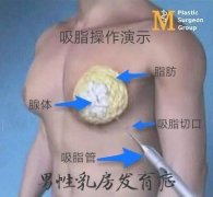 男人胸部燃烧脂肪快的方法(如何燃烧胸部脂肪)