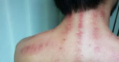 腿部拔罐多可以瘦腿(腿上拔罐可以瘦大腿吗)