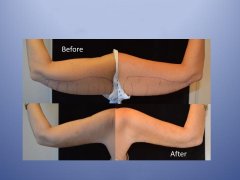 小胳膊粗怎么减掉(胳膊粗怎么能减掉)