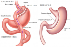手术减肥的方法(怎么手术减肥)