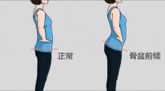 挺胸时臀部太翘怎么锻炼(挺胸时臀部太翘怎么锻炼视频)