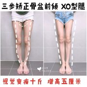 腿型xo怎么改(XO腿型怎么矫正)