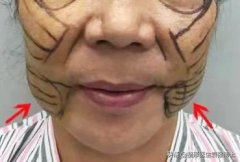 双重下巴怎么减(双重下巴怎么减掉)