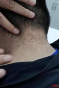 脖子上的肥肉怎么减(脖子的肥肉怎么减下去)