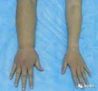 经期怎么避免水肿(经期怎么避免水肿的发生)